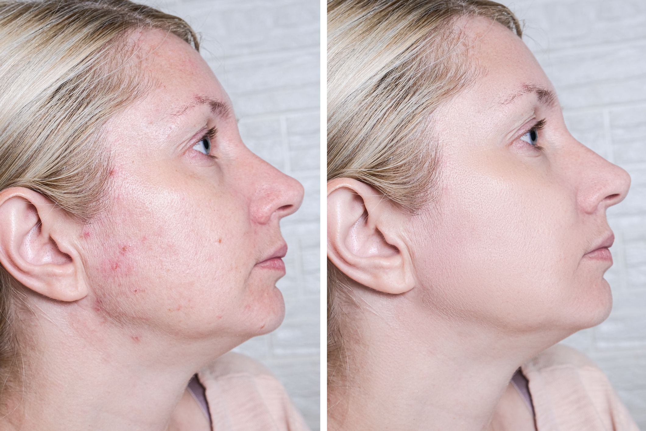 Acne Subcison in Carlsbad, CA