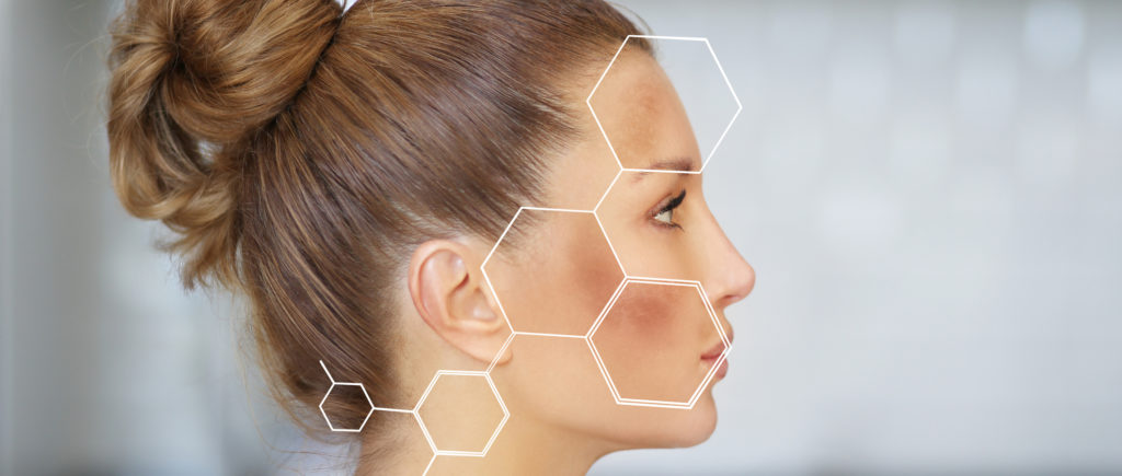 Melasma treatment options at Glow Theory in Carlsbad