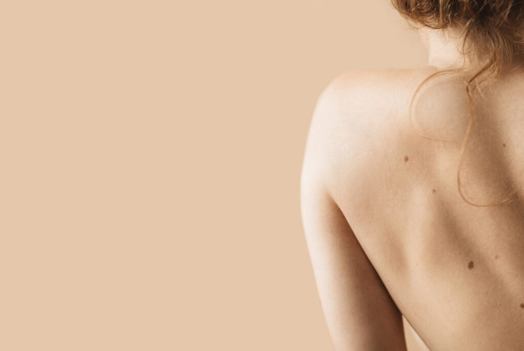 Cautery treatment at Glow Theory in Carlsbad