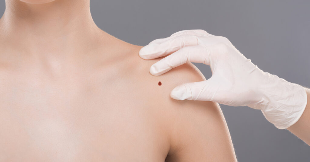 Skin biopsy options at Glow Theory in Carlsbad