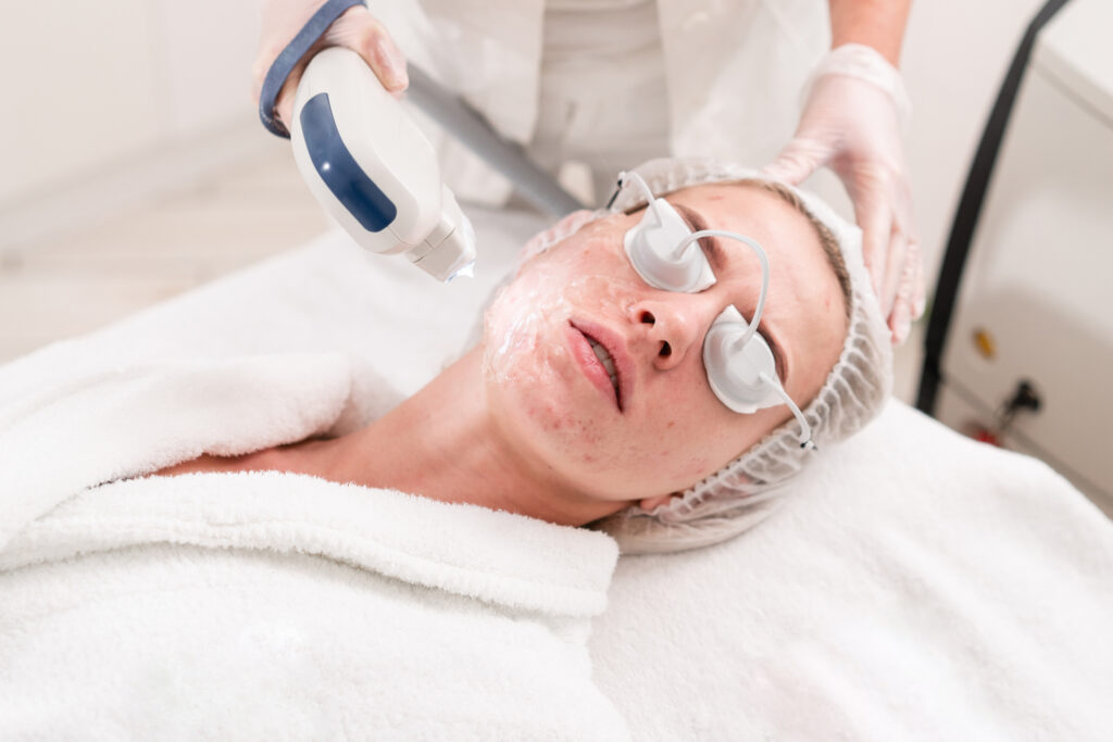 Acne scar treatment options at Glow Theory in Carlsbad