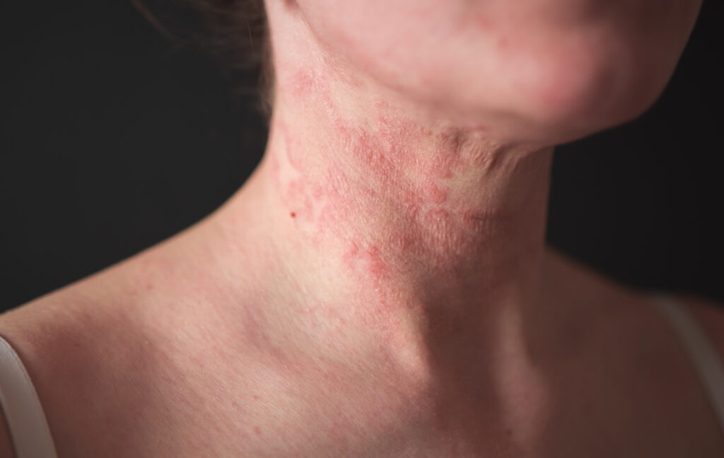 Eczema treatment options at Glow Theory in Carlsbad