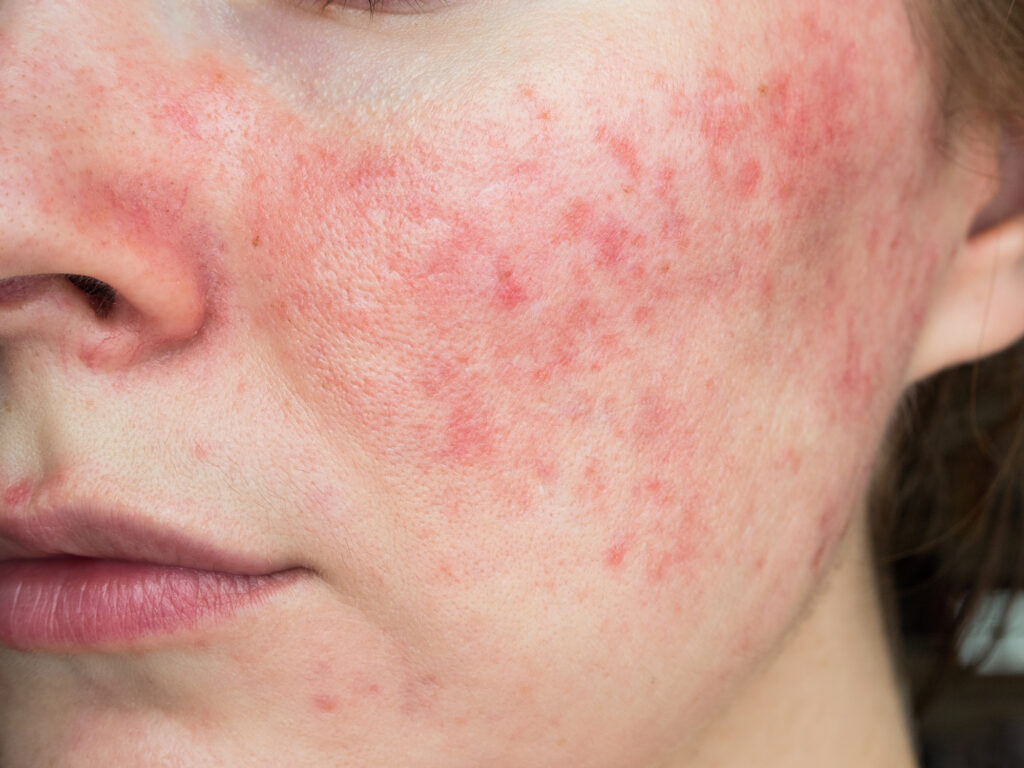 Clear, glowing skin after acne treatment at Glow Theory
