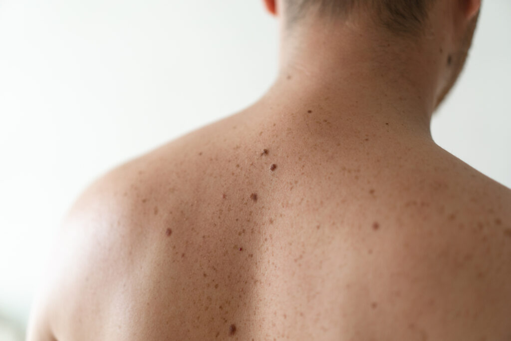 Mole and skin growth treatment options at Glow Theory in Carlsbad