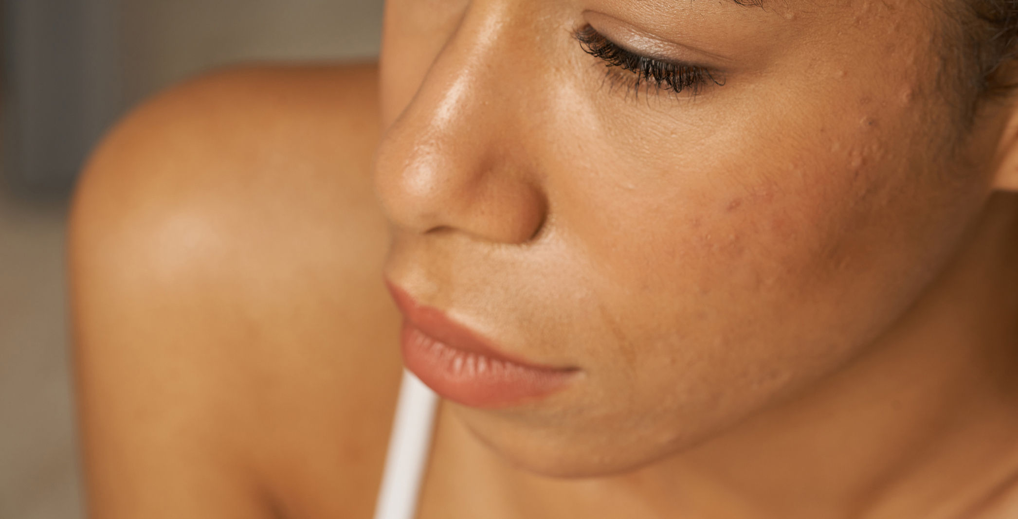 Acne scar subcision at Glow Theory Aesthetic & Dermatology Studio in Carlsbad