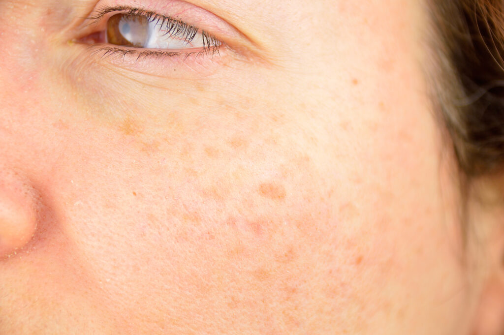 Age spots treatment in Carlsbad at Glow Theory