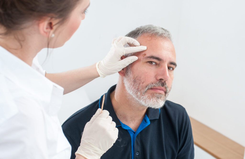 Age spot treatment options at Glow Theory in Carlsbad