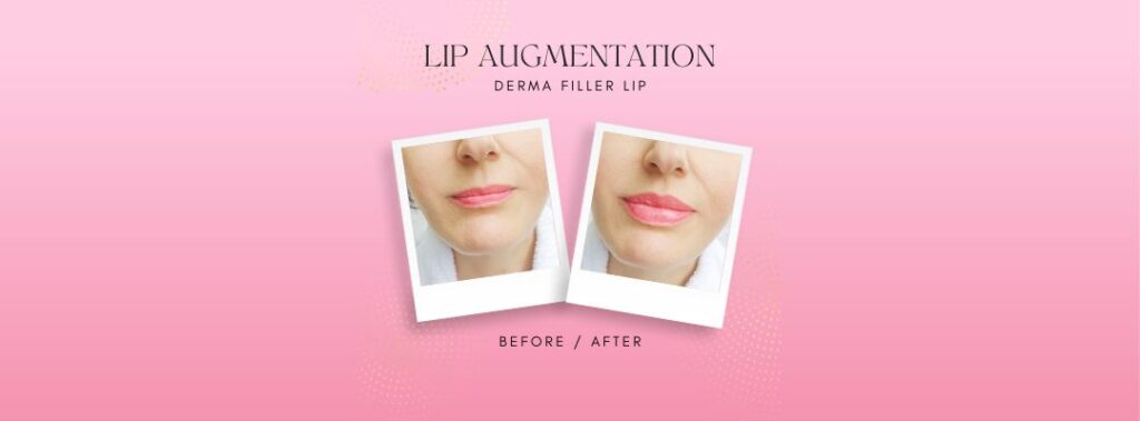Risks and Side Effects of Lip Augmentation