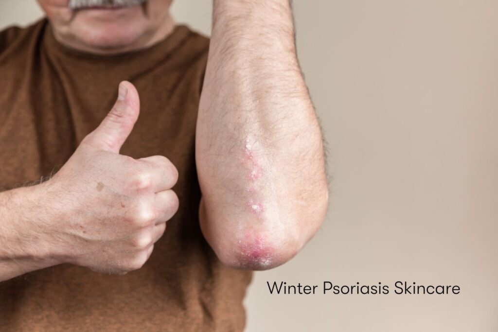 Winter Psoriasis Skincare