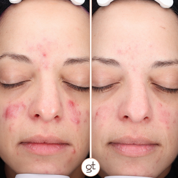 Acne Transformation - Before and After