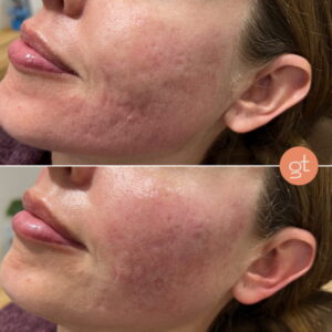 Acne Treatment Before After 2