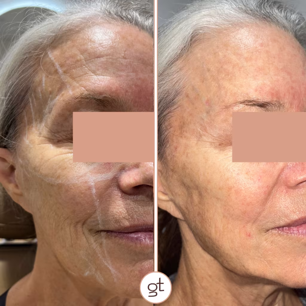 Cheek Filler Result 2 before and after