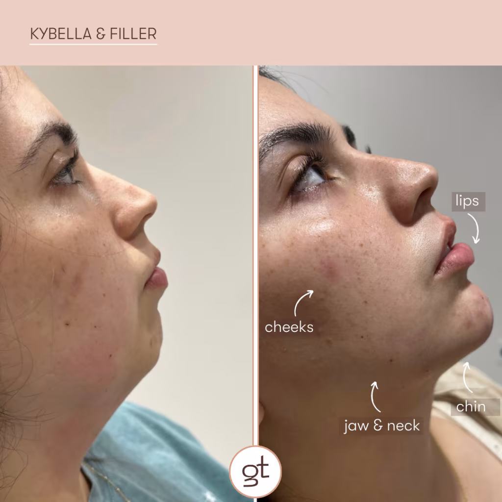 Kybella & Filler Result 1 before and after