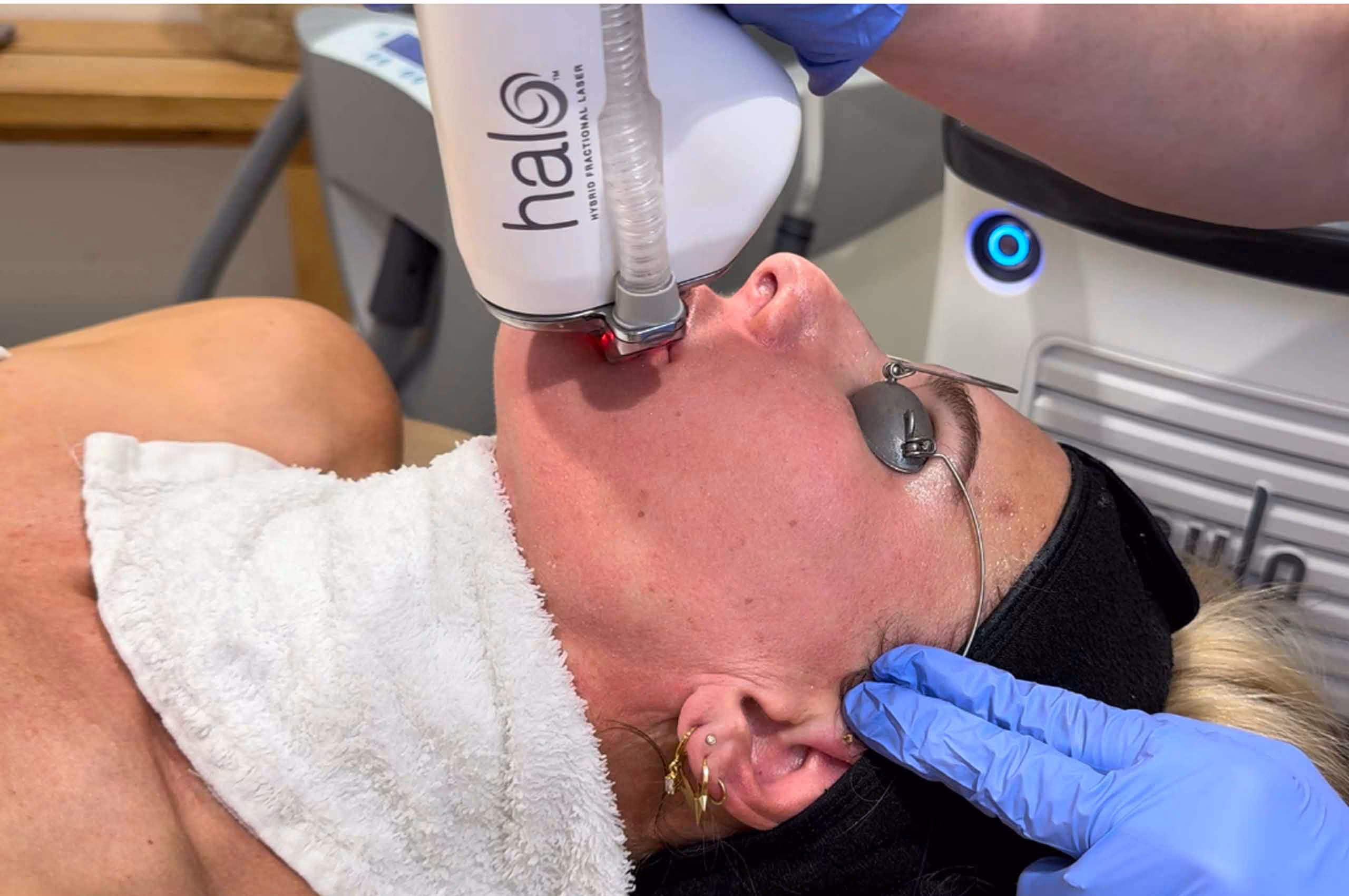 HALO laser skin resurfacing at Glow Theory Aesthetic & Dermatology Studio in Carlsbad