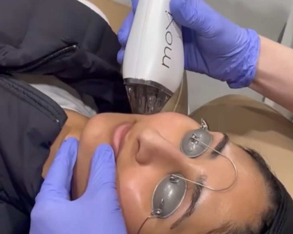 What MOXI laser treats: sun damage, pigmentation and texture, at Glow Theory in Carlsbad