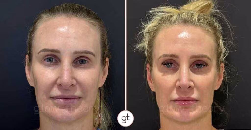 Sofwave Before After Carlsbad