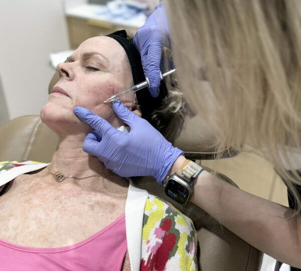 Areas of the face treated with dermal fillers at Glow Theory in Carlsbad