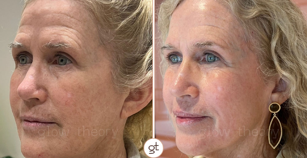 Wedding Glow Up skin results in Carlsbad, CA