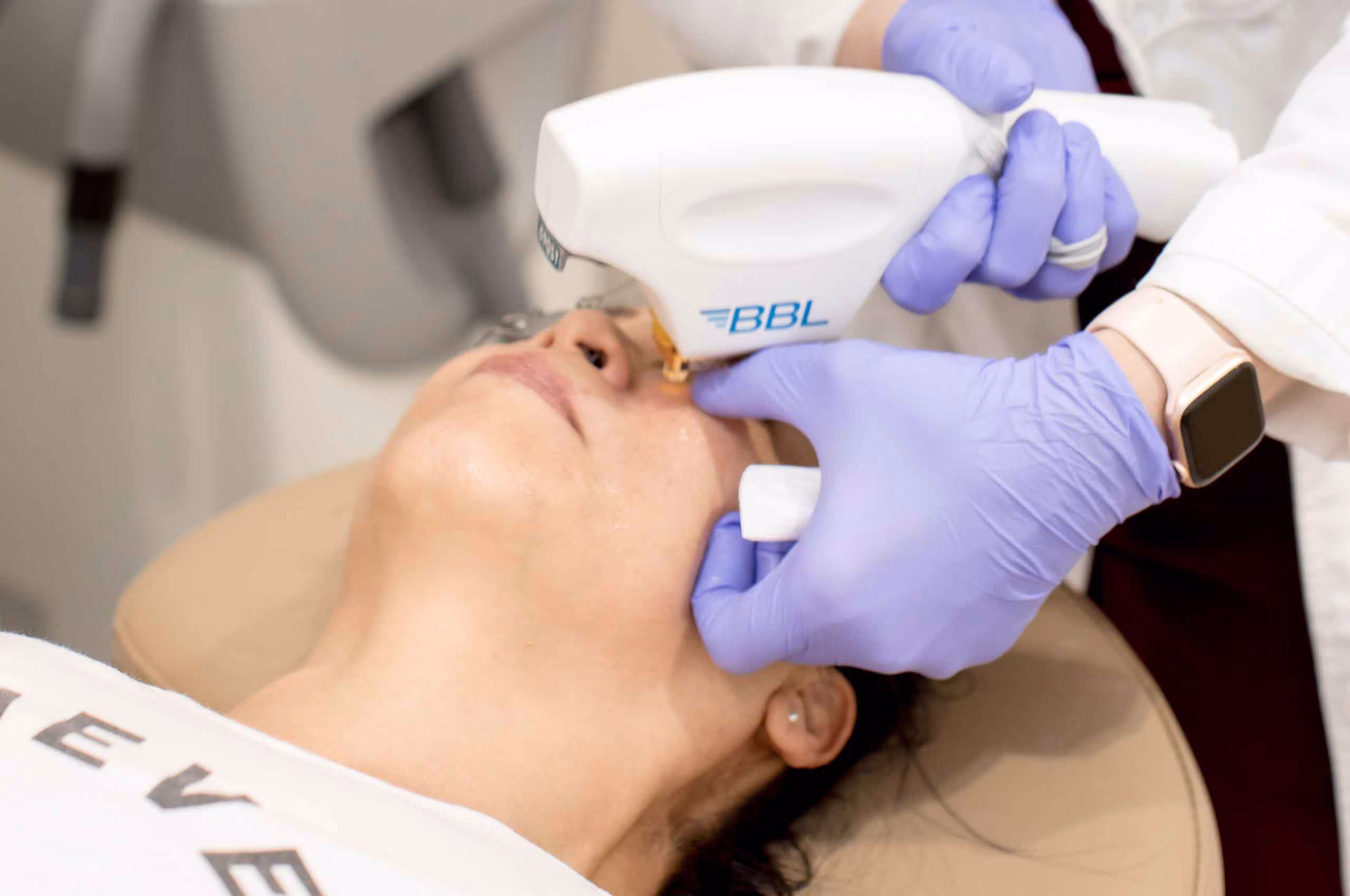 BBL HERO photofacial at Glow Theory Aesthetic & Dermatology Studio in Carlsbad