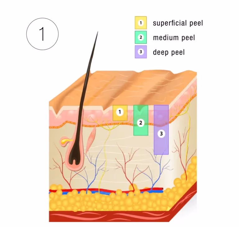 Chemical peel phase 1: the peel loosens damaged surface skin cells