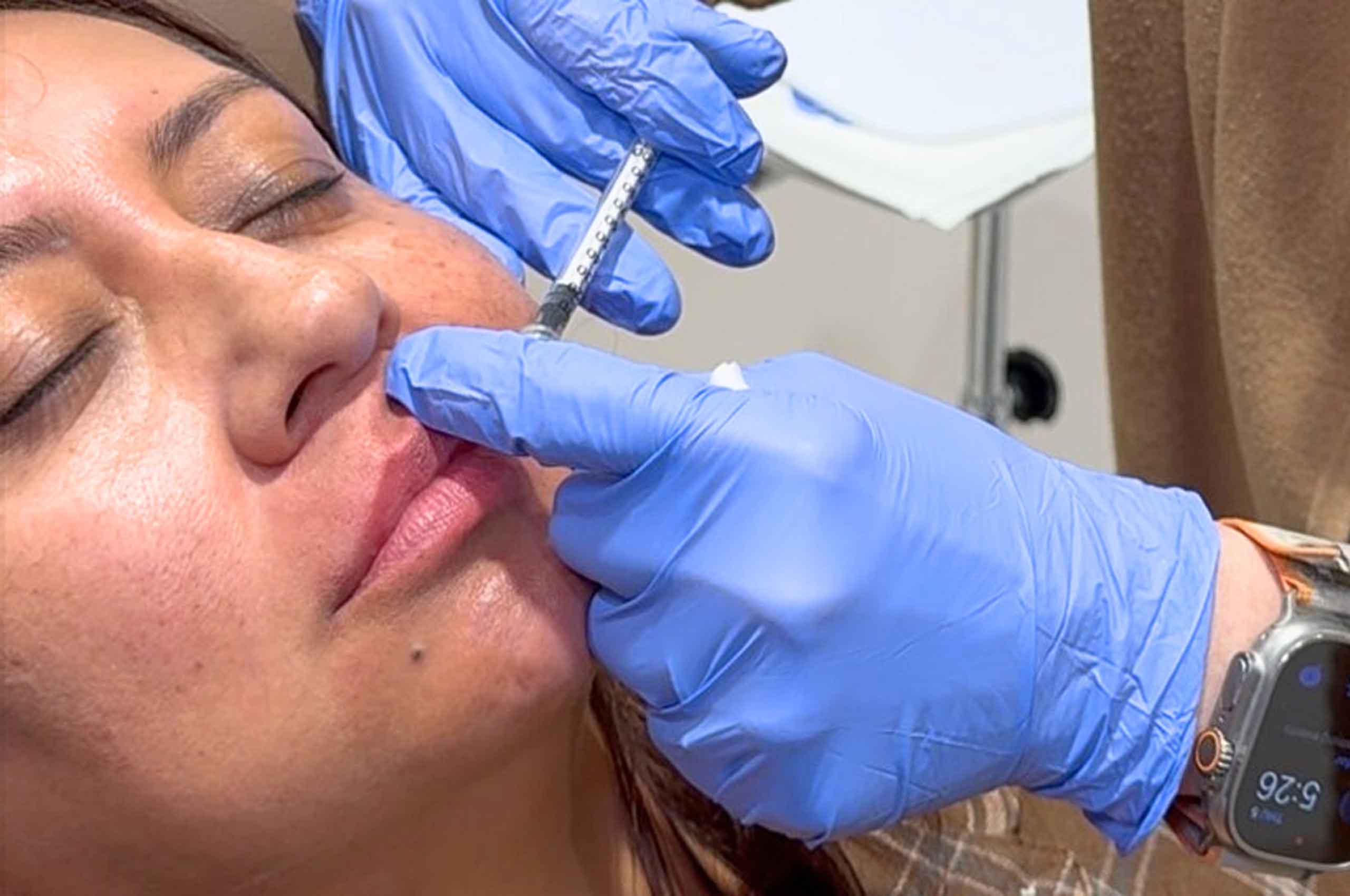 Filler dissolver treatment at Glow Theory Aesthetic & Dermatology Studio in Carlsbad