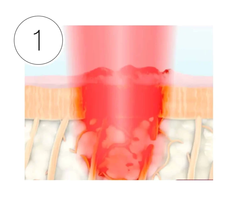HALO laser phase 1: HALO™ Laser accurately emits light waves to treat skin
