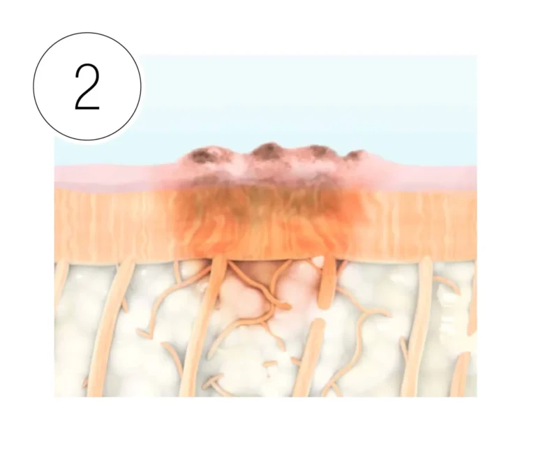 HALO laser phase 2: 1-12 hours: Natural healing process begins