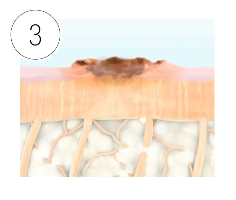 HALO laser phase 3: 2-24 hours: Skin may be rough and/or bronzed