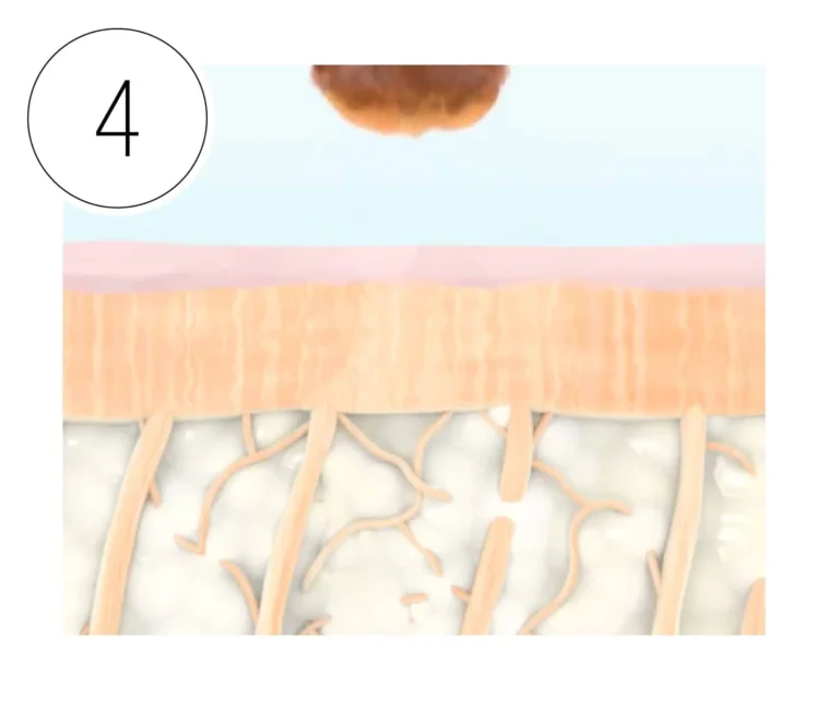 HALO laser phase 4: Old skin peels off revealing fresher, smoother skin