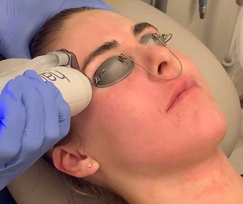 HALO laser treatment areas at Glow Theory in Carlsbad