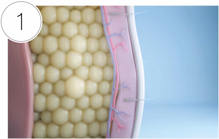 CoolSculpting step: Stubborn Fat