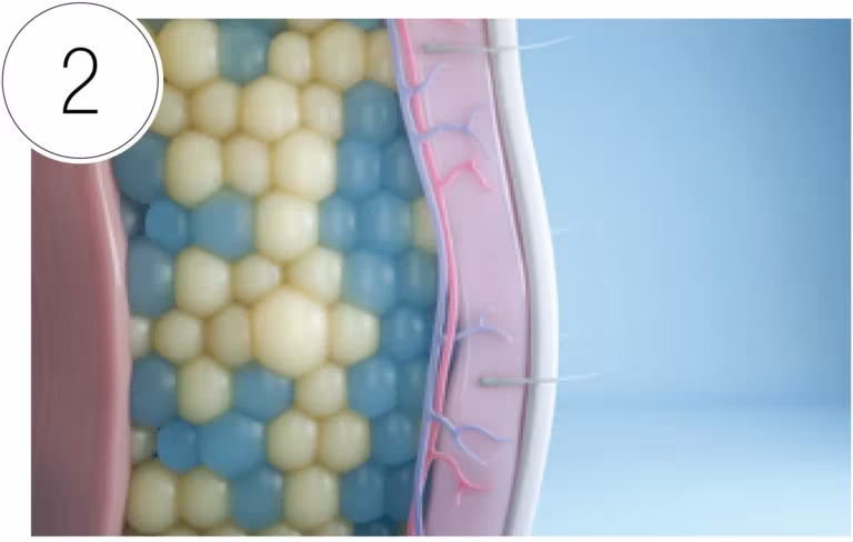 CoolSculpting step: Fat Cells Frozen