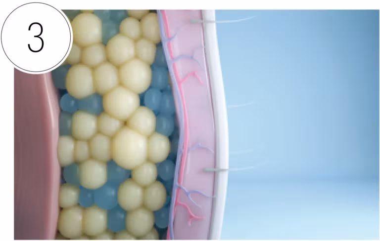 CoolSculpting step: Fat Cells Eliminated