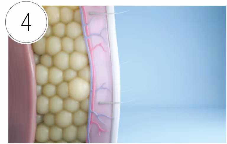 CoolSculpting step: Gone for Good