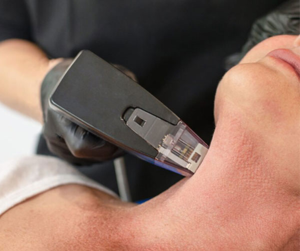 The Morpheus8 RF microneedling experience at Glow Theory in Carlsbad