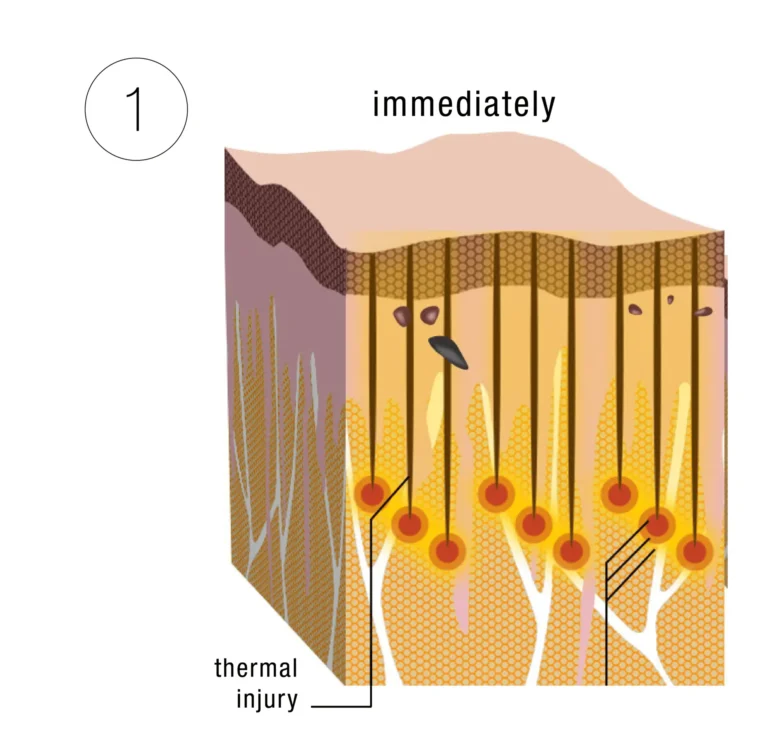 Morpheus8 phase 1: Fine needles create tiny channels and deliver radiofrequency energy to the depth chosen for your skin.