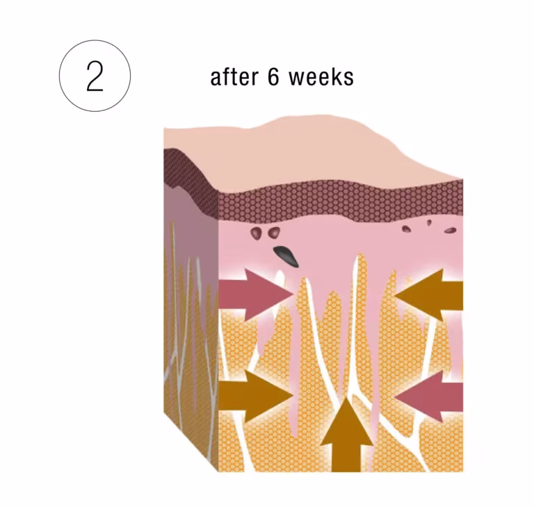Morpheus8 phase 2: The heat triggers new collagen and elastin, which firm, tighten and smooth the skin over the following months.