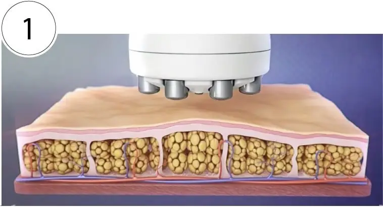 SkinTyte phase 1: Pulses of infrared light gently heat the deeper layers of the skin while the surface stays protected.