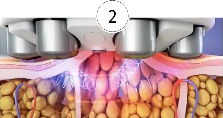 SkinTyte phase 2: The heat tightens existing collagen fibres, so skin can feel firmer soon after treatment.