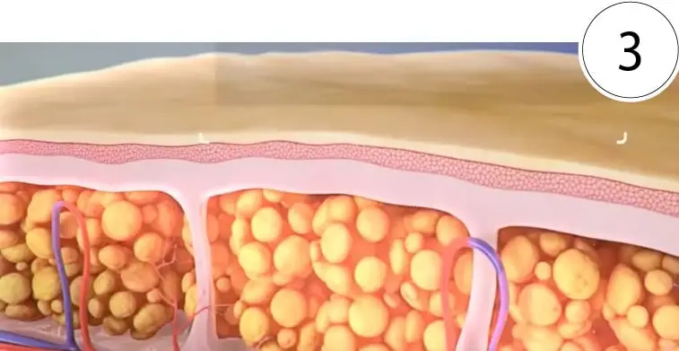 SkinTyte phase 3: Over the following months the skin makes new collagen, for firmer, smoother and lifted-looking skin.