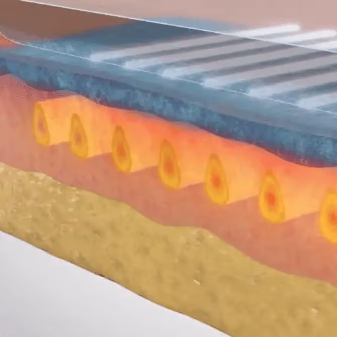 Sofwave phase 1: During a Sofwave session, a specialist uses a cutting-edge handheld device that delivers synchronous ultrasound parallel beam technology to the treatment site.