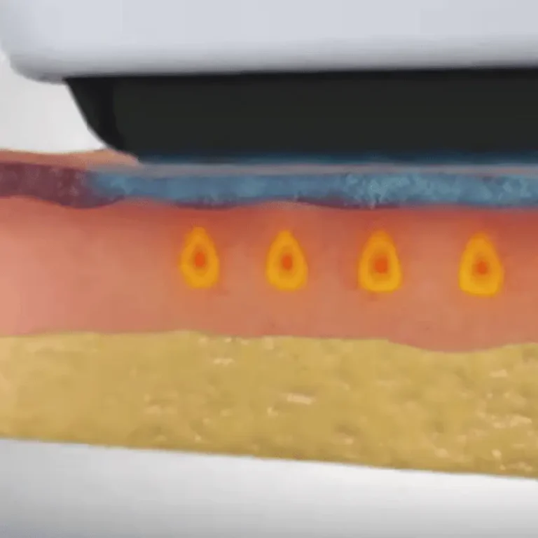Sofwave phase 2: The ultrasound energy gently heats the mid-dermis at a depth of 1.5 mm, while SofCool™ keeps the skin surface protected.