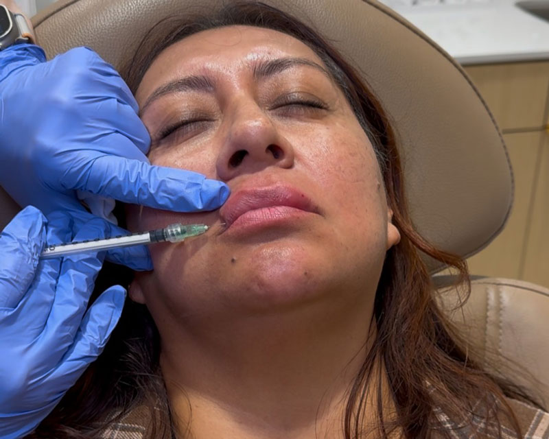 What filler dissolver does: correcting lip and cheek filler at Glow Theory in Carlsbad