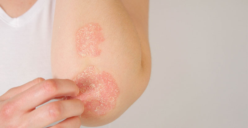 Recommended psoriasis treatments at Glow Theory in Carlsbad