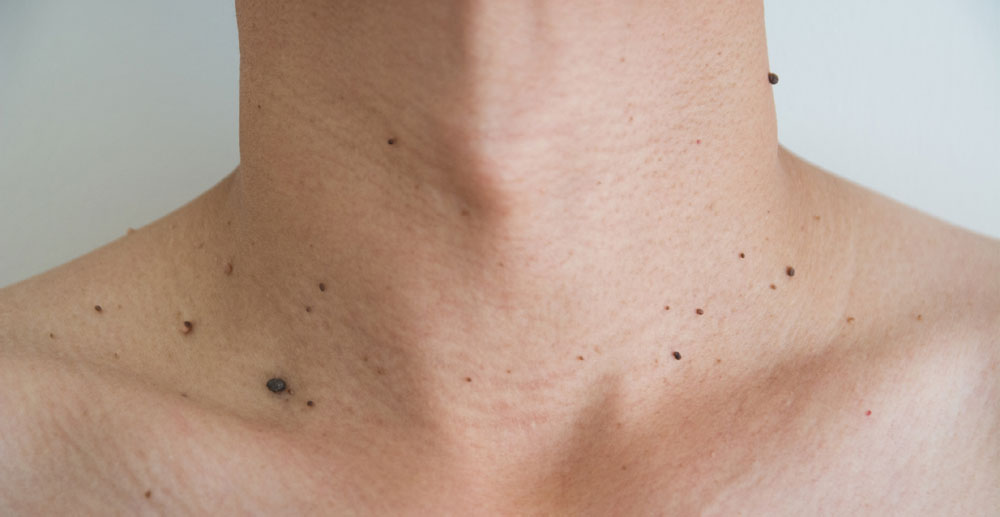 Lesions recommended for cautery in Carlsbad