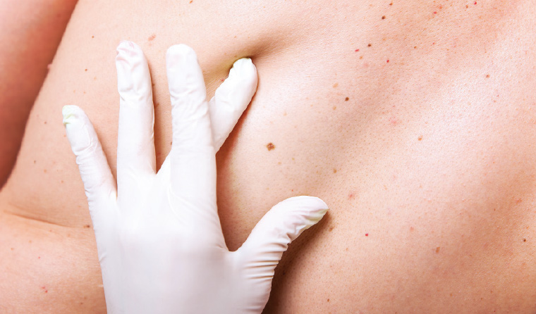 Why choose Glow Theory for a skin lesion biopsy in Carlsbad