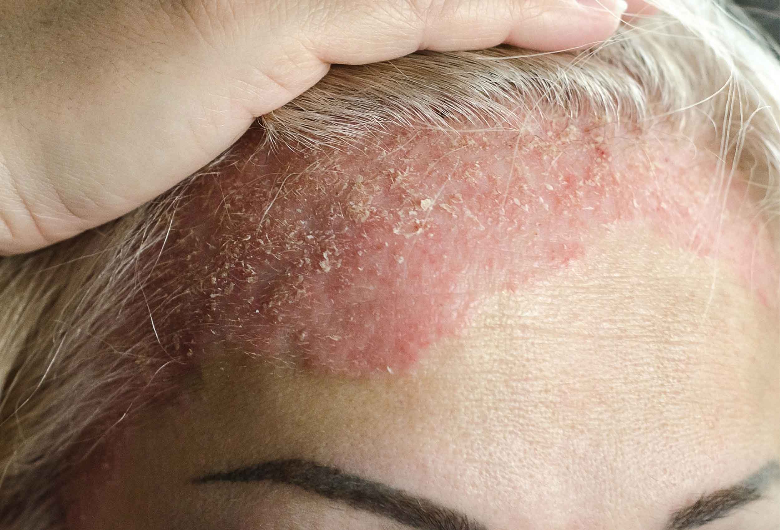 Psoriasis treatment at Glow Theory Aesthetic & Dermatology Studio in Carlsbad