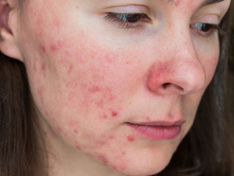 Recommended rosacea treatments at Glow Theory in Carlsbad
