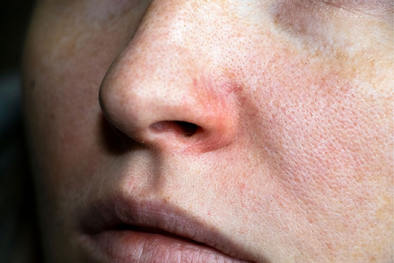 Recommended skin rash treatments at Glow Theory in Carlsbad