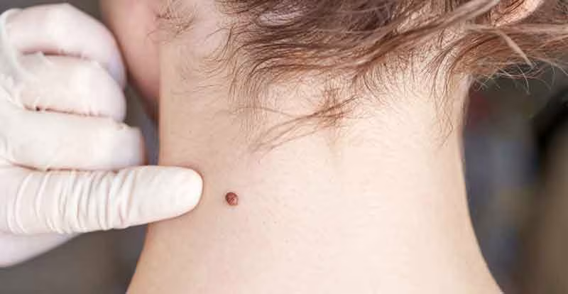 Recommended wart treatments at Glow Theory in Carlsbad